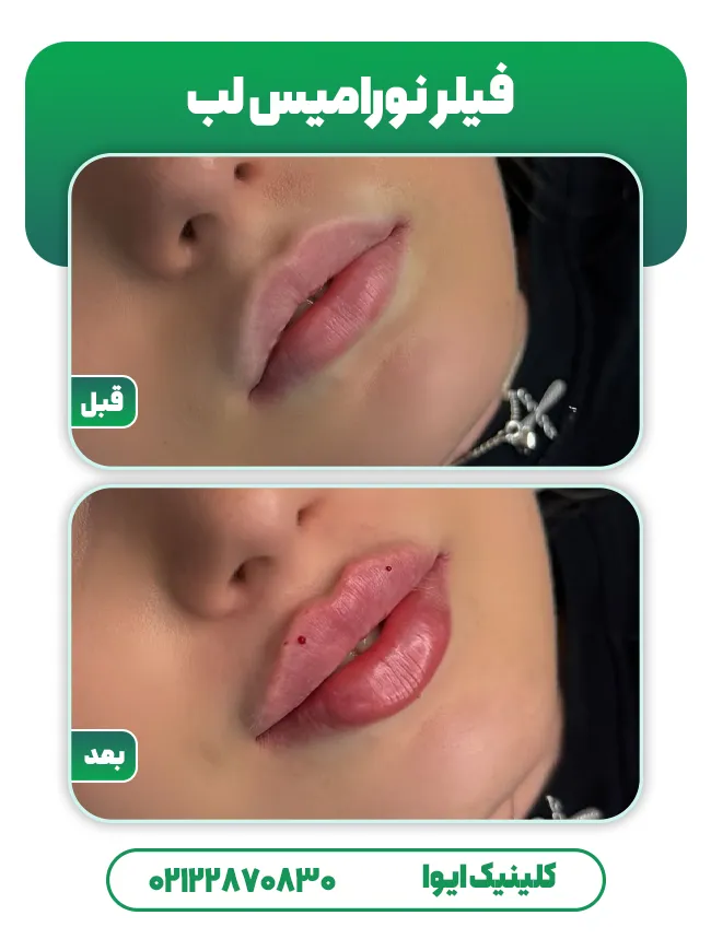 فیلر لب نورامیس