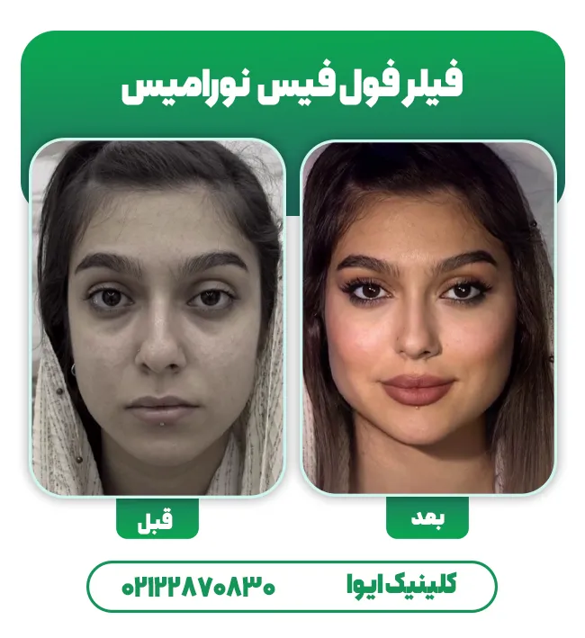 تزریق فول فیس نوورامیس