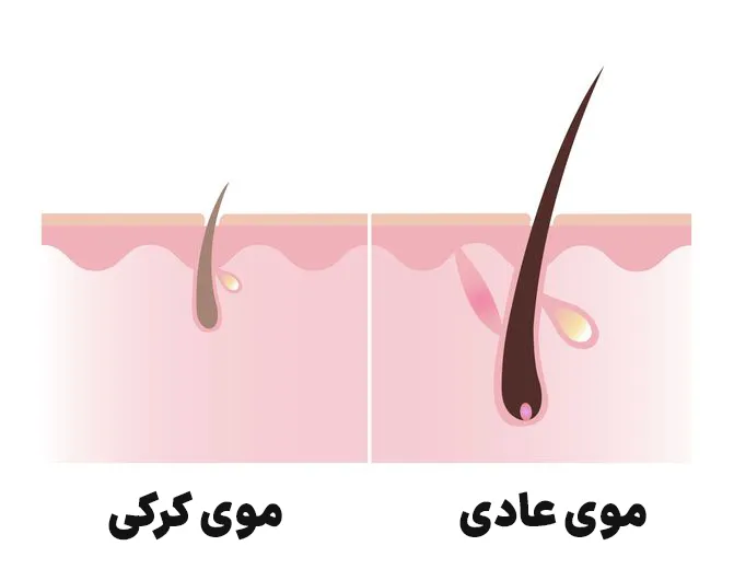 موهای کرکی