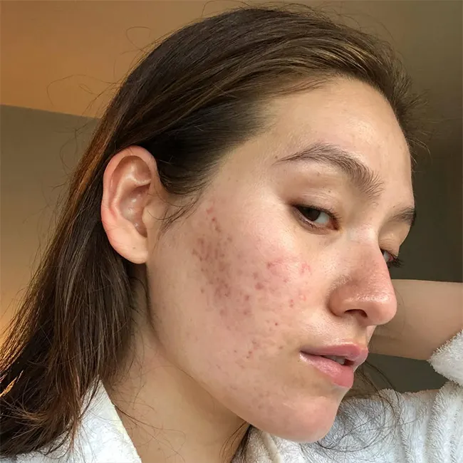 جای جوش فرورفته