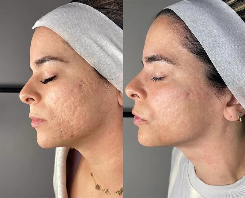 جای جوش فرورفته