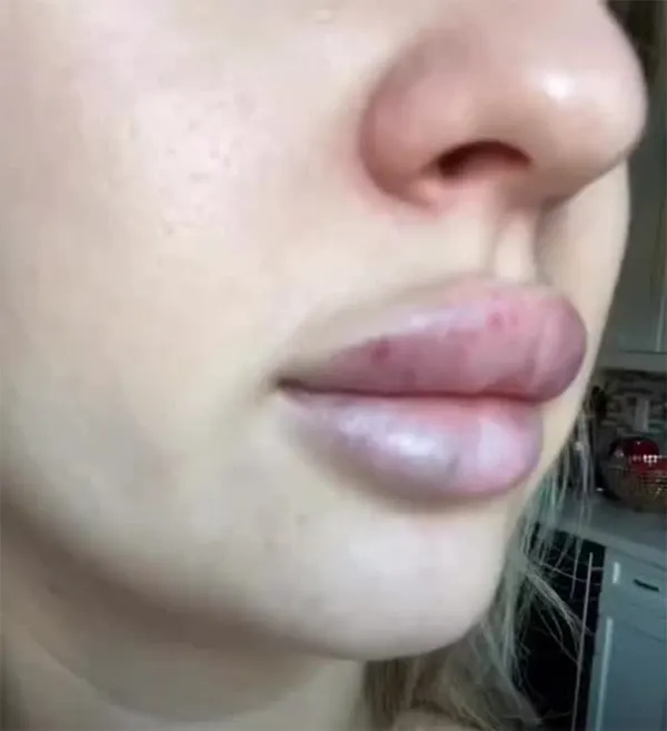 عوارض تزریق چربی لب