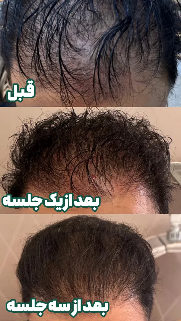 میکرونیدلینگ مو