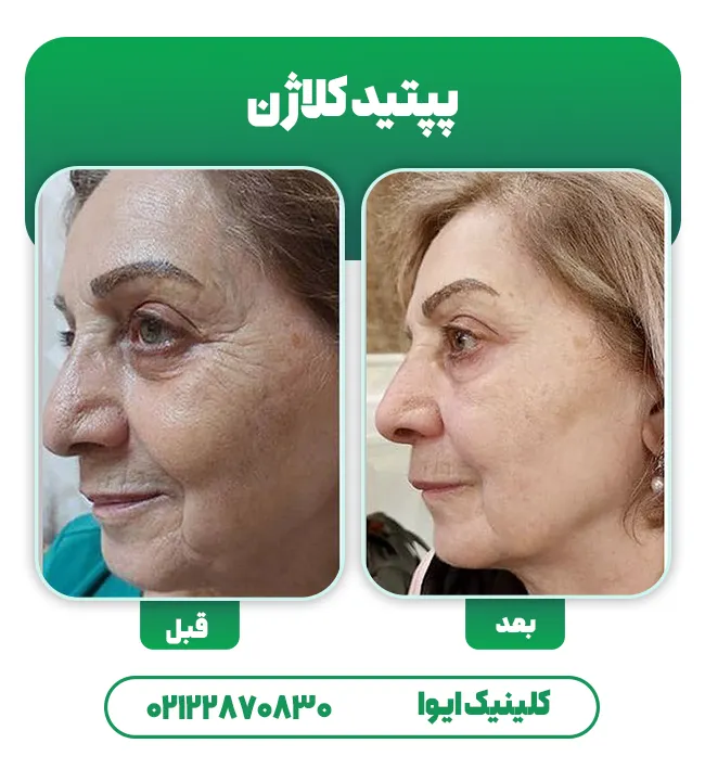 قبل بعد تزریق پپتید کلاژن