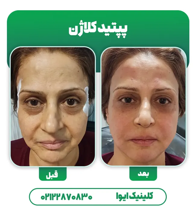 قبل بعد تزریق پپتید کلاژن