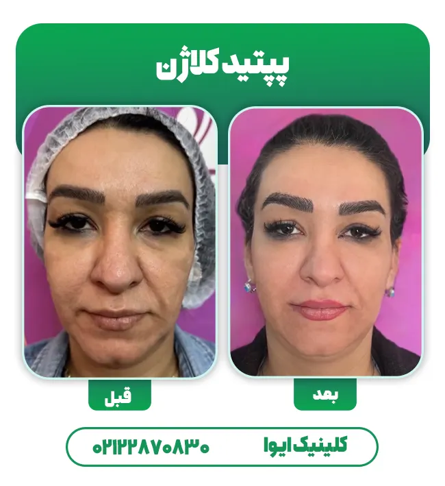 قبل بعد تزریق پپتید کلاژن