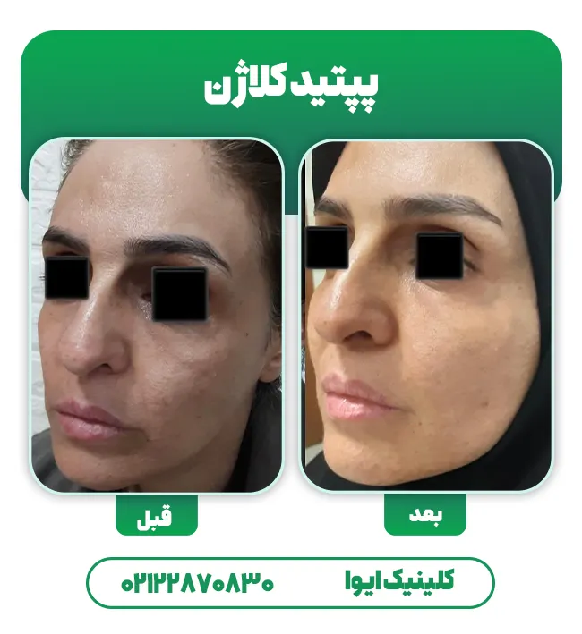 قبل بعد تزریق پپتید کلاژن