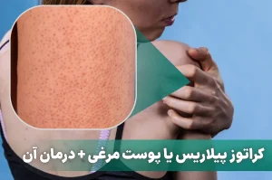 کراتوز پیلاریس یا پوست مرغی