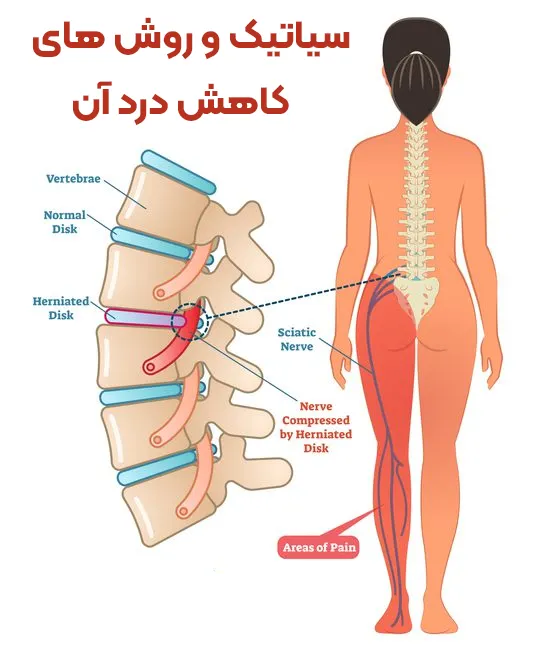 سیاتیک