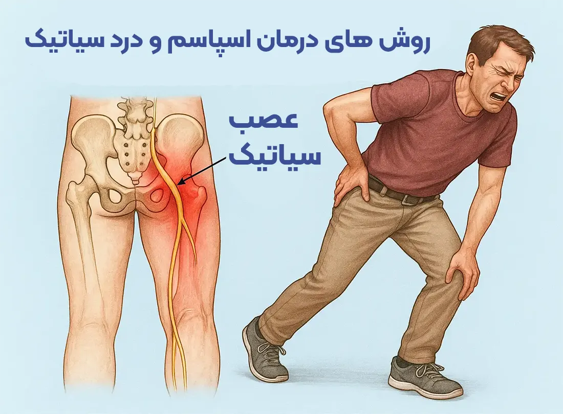 سیاتیک