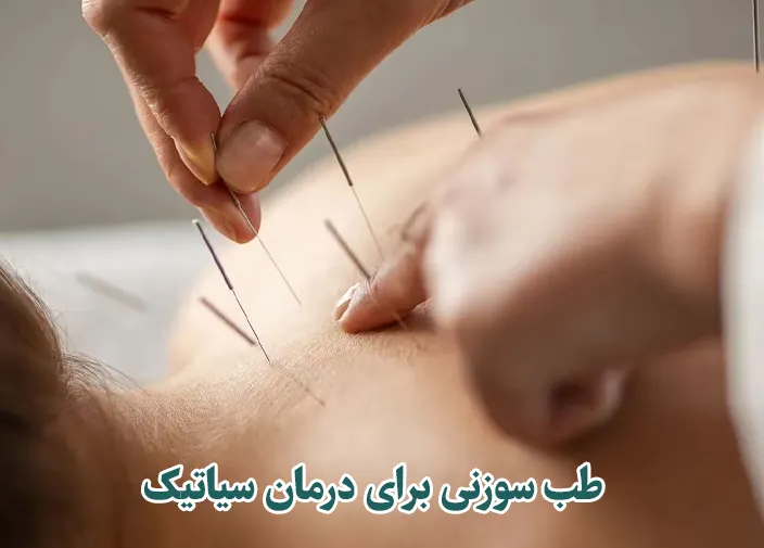 طب سوزنی برای درمان سیاتیک