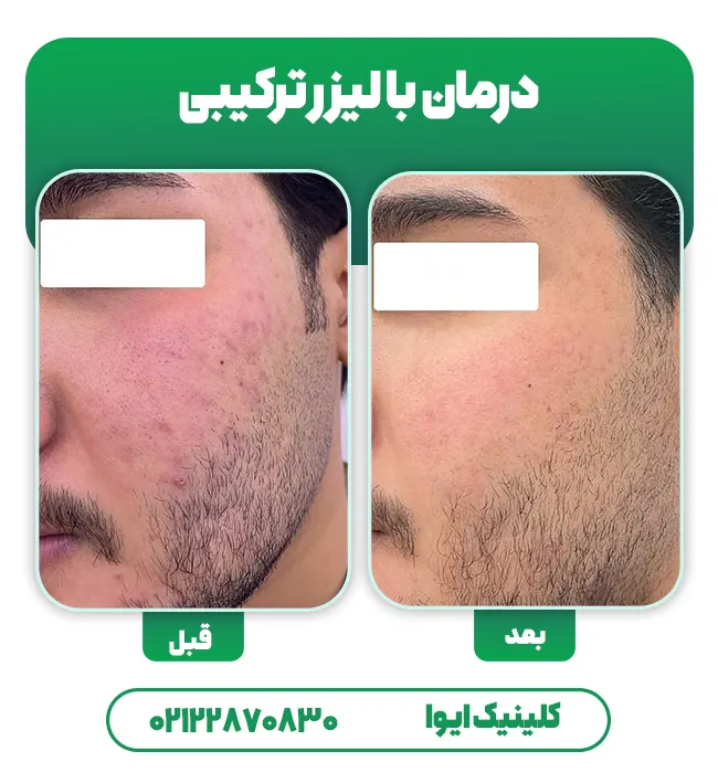 درمان اسکار با لیزر