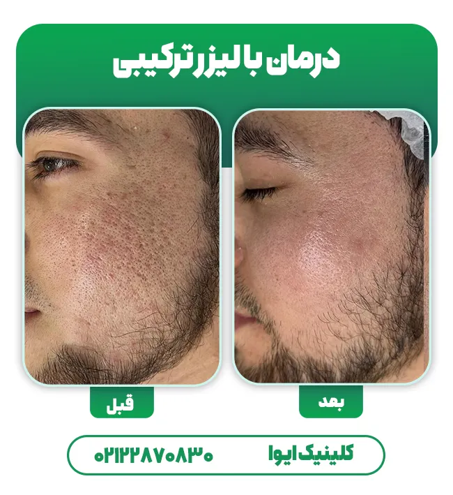 درمان اسکار با لیزر