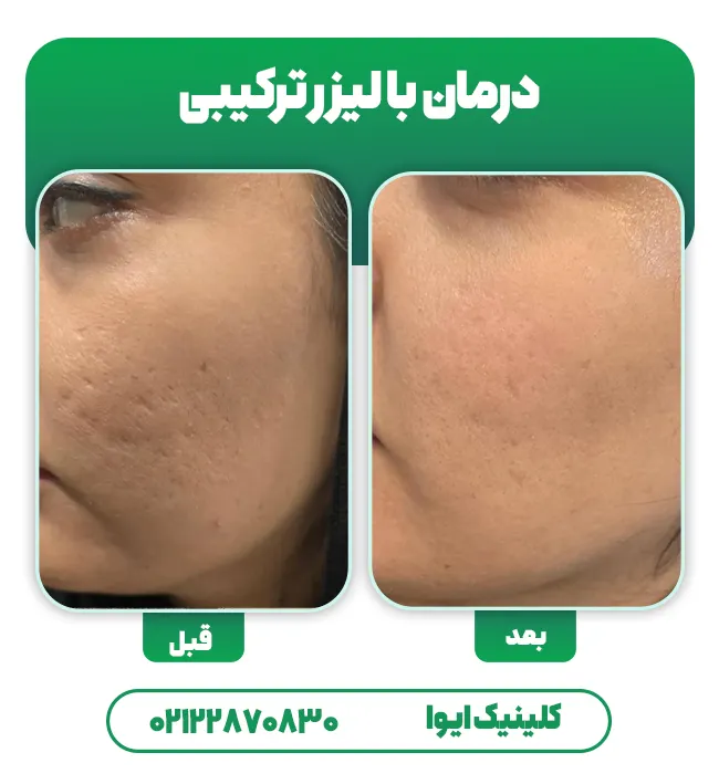 درمان اسکار با لیزر