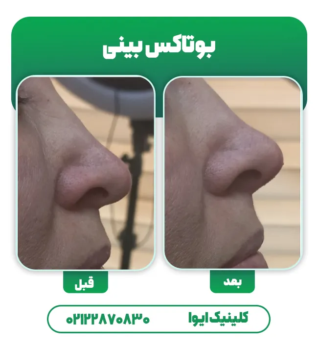 تزریق بوتاکس بینی
