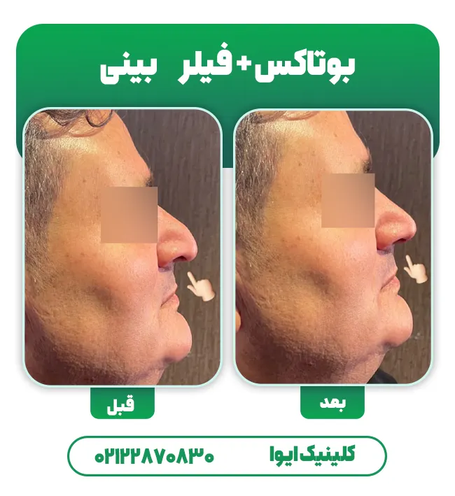 تزریق بوتاکس و فیلر بینی