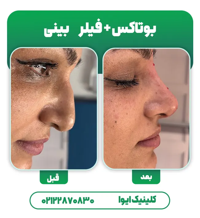 تزریق فیلر با بوتاکس بینی
