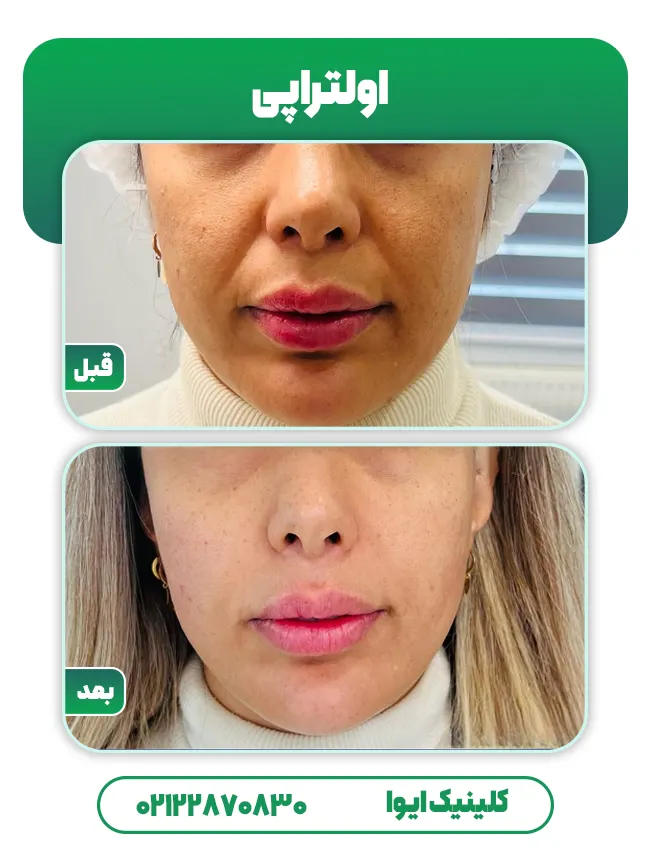 اولتراپی صورت