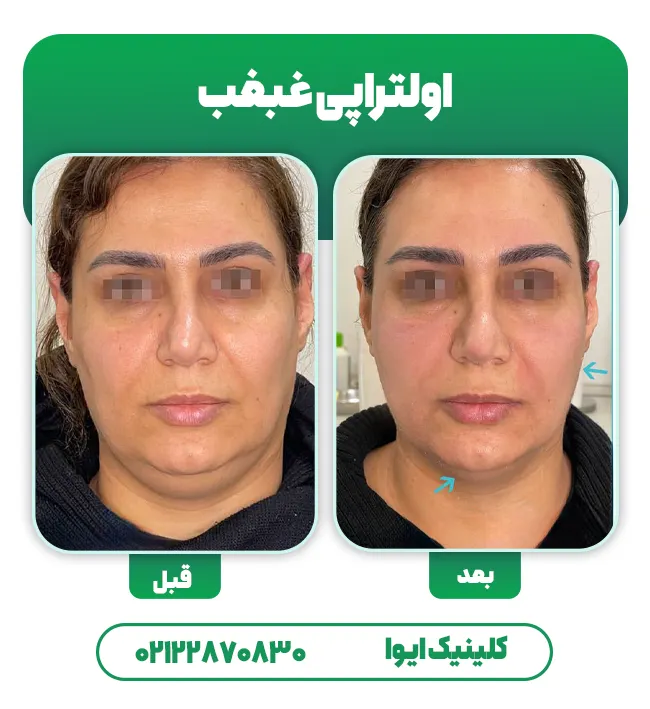 اولتراپی غبغب