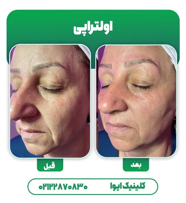 اولتراپی صورت