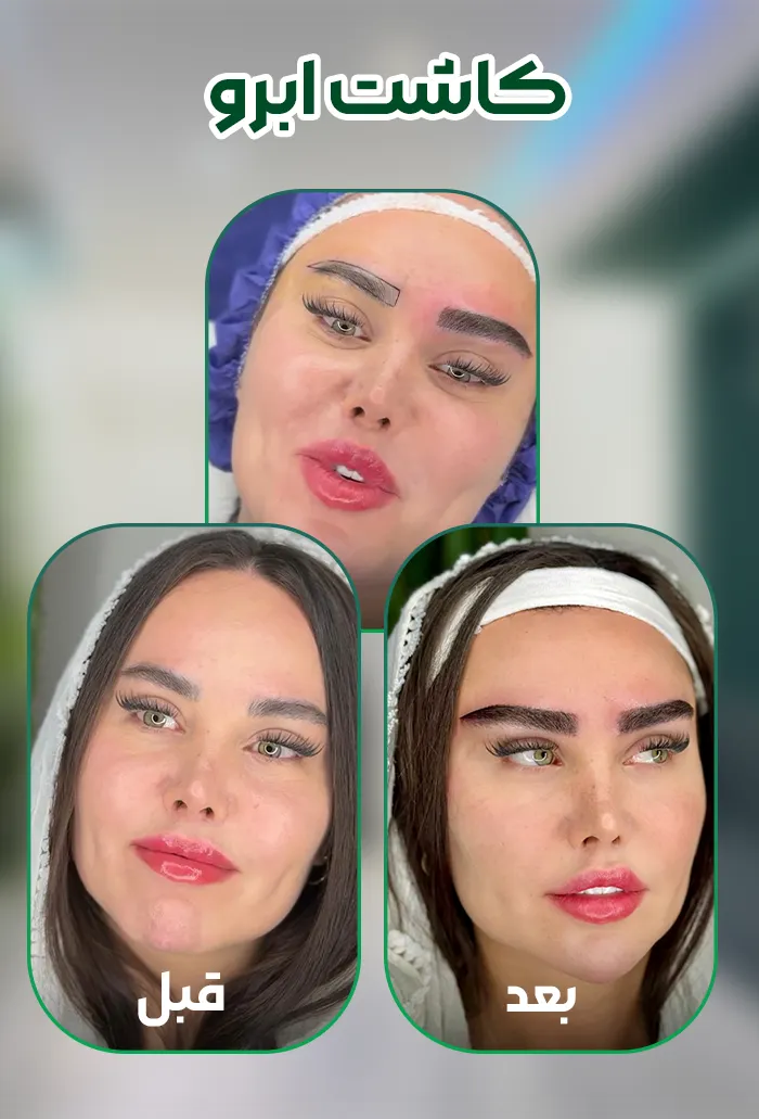 کاشت ابرو