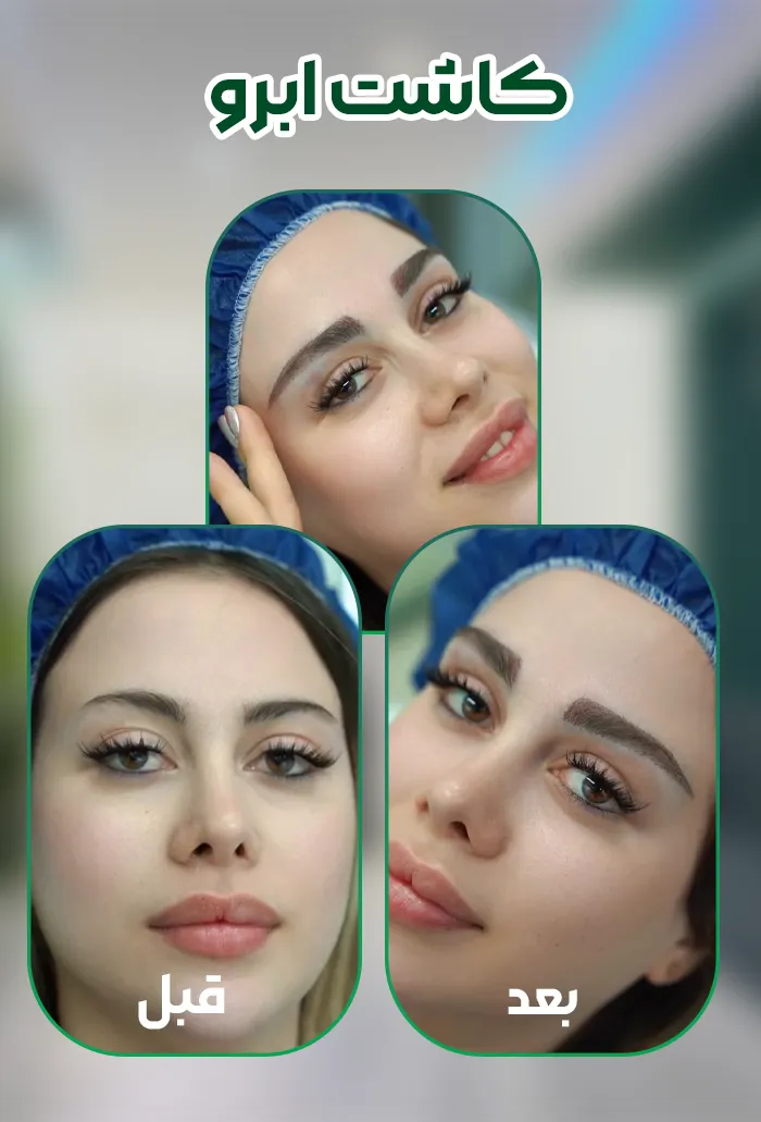کاشت ابرو