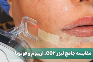 مقایسه جامع لیزر CO2 فرکشنال با لیزر فوتونا و اربیوم