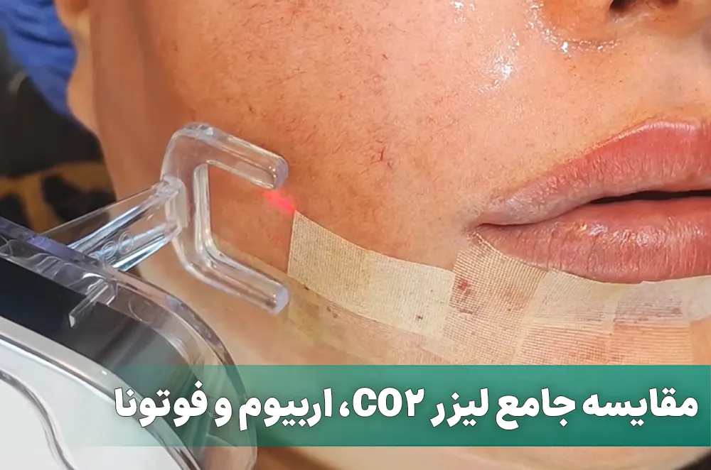 مقایسه جامع لیزر CO2 فرکشنال با لیزر فوتونا و اربیوم