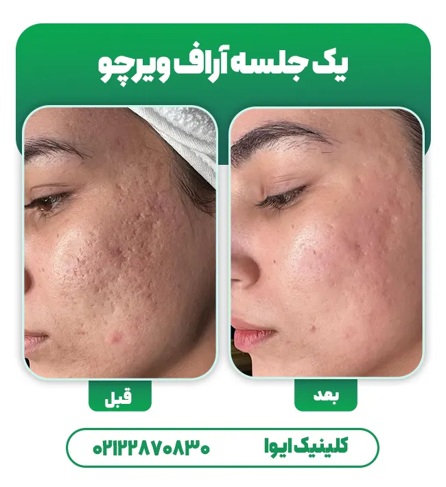قبل و بعد آراف فرکشنال