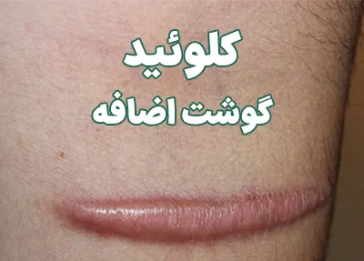 کلوئید