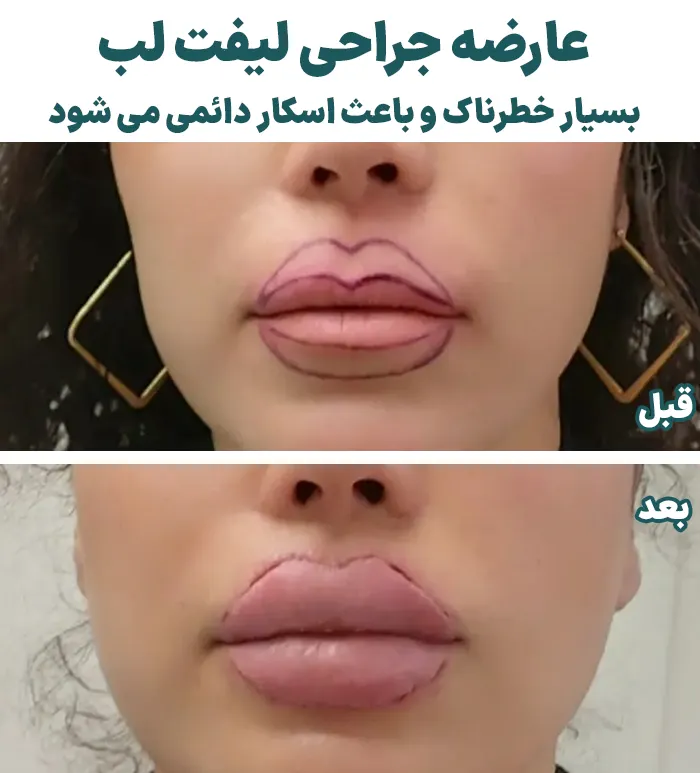 عوارض لیفت سانترال لب