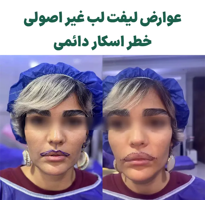 عوارض لیفت لب
