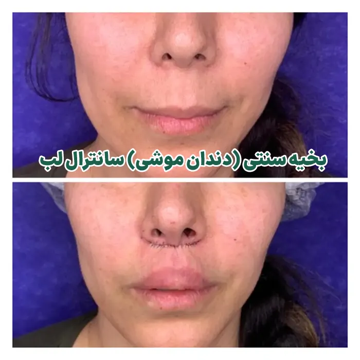 رد بخیه لیفت سانترال