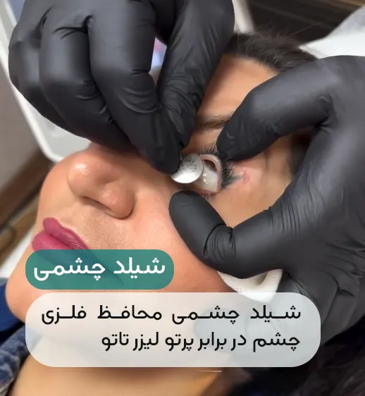 شیلد محافظ در لیزر خط چشم