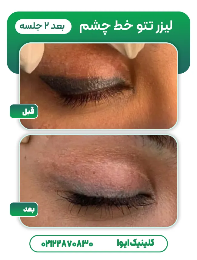 قبل و بعد لیزر تاتو خط چشم