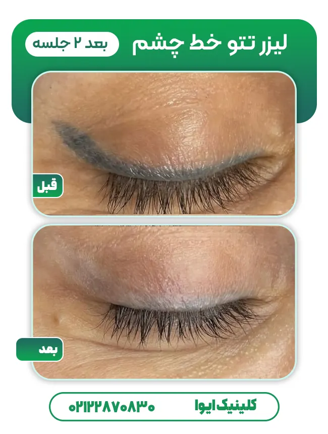 لیزر خط چشم قبل بعد