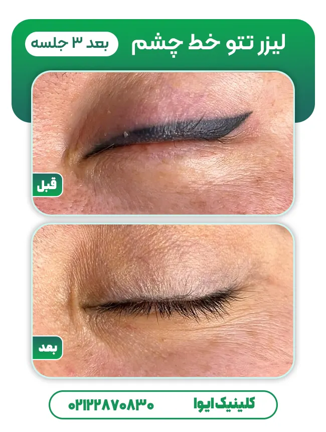 قبل و بعد لیزر تاتو خط چشم