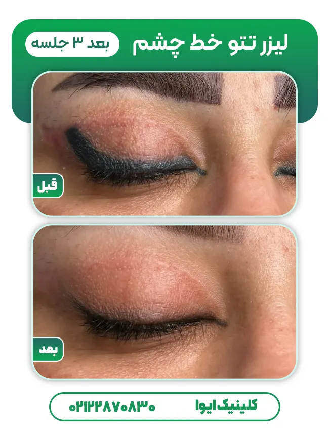 قبل و بعد لیزر تاتو خط چشم