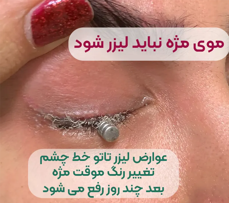 سفیدی مژه بعد لیزر خط چشم