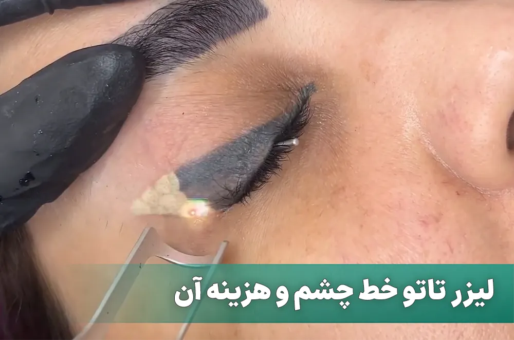 لیزر تاتو خط چشم