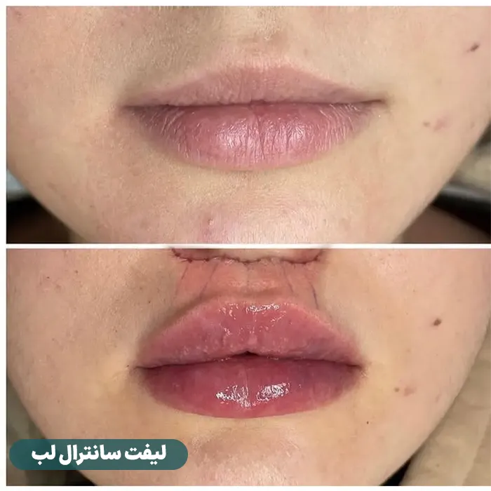 قبل و بعد لیفت سانترال لب