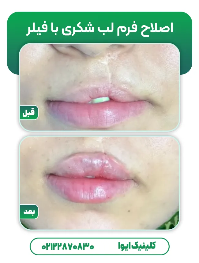 اصلاح فرم لب شکری با فیلر