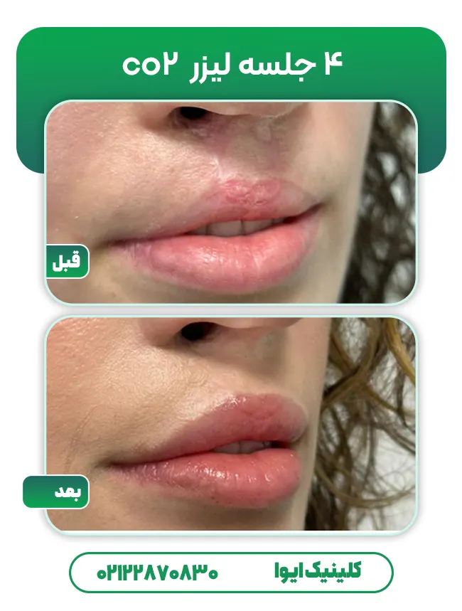 لیزر CO2 برای اسکار لب شکری