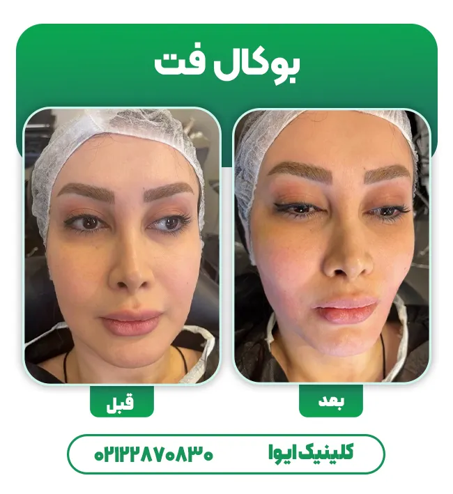 قبل و بعد تخلیه بوکال