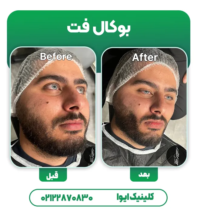 عکس قبل و بعد بوکال فت