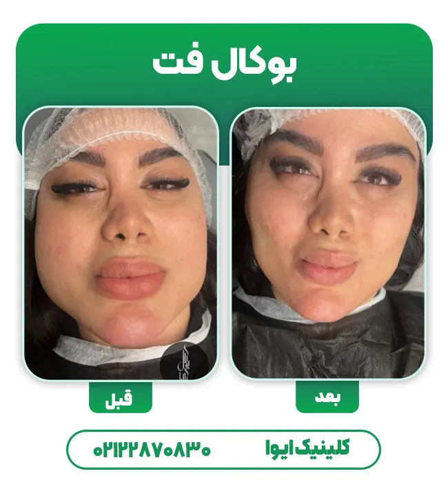 قبل و بعد بوکال فت