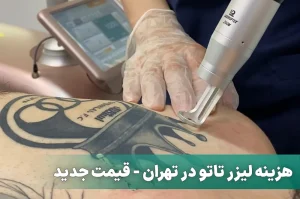 هزینه لیزر تاتو در تهران