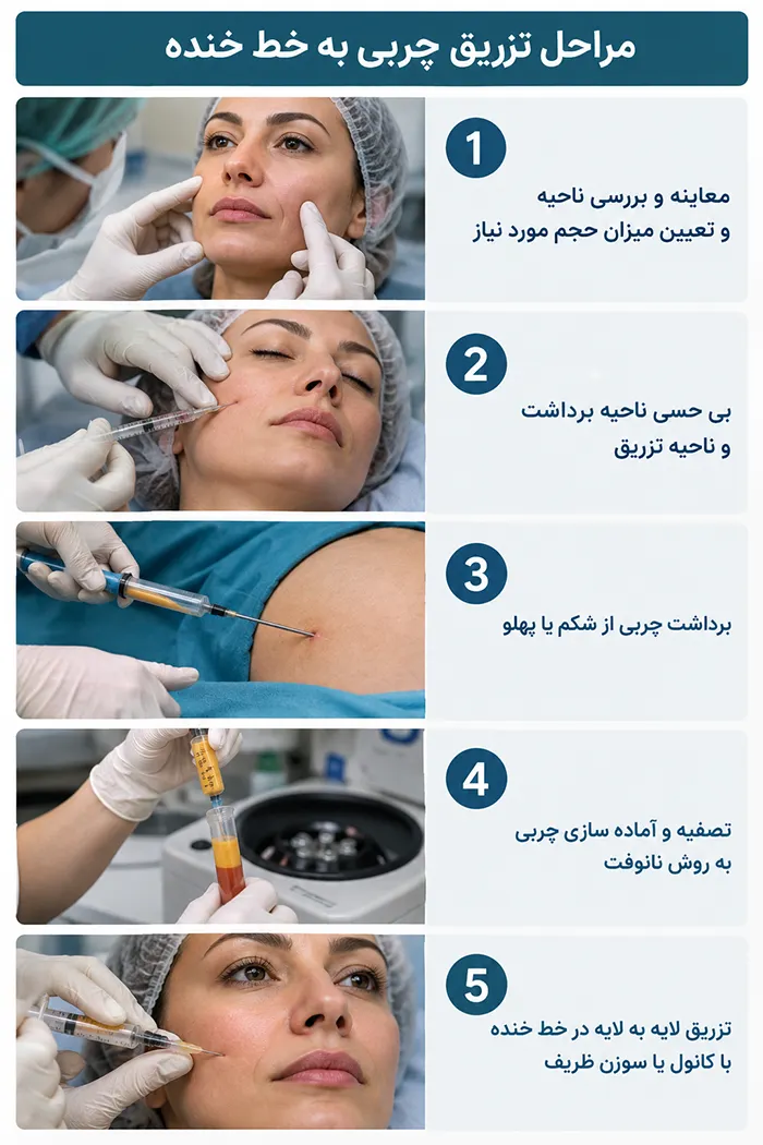 مراحل تزریق چربی به خط خنده