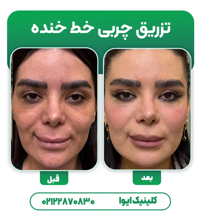 تزریق چربی به خط خنده