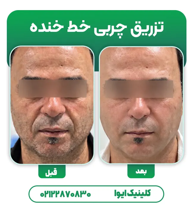 تزریق چربی به خط خنده